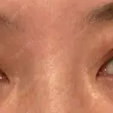 眼瞼下垂（切開） くさのたろうクリニック DAY 21 サムネイル用
