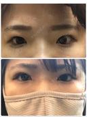 二重埋没 / 目頭切開 湘南美容クリニック 京都院 DAY 10 サムネイル用