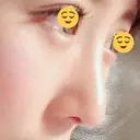 鼻尖形成（切開） / 鼻中隔延長（切開） / 軟骨移植 / 鼻翼基部形成（貴族手術） HANABI整形外科 DAY 44 サムネイル用