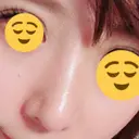 鼻尖形成（切開） / 鼻中隔延長（切開） / 軟骨移植 / 鼻翼基部形成（貴族手術） HANABI整形外科 DAY 44 サムネイル用