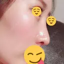 鼻尖形成（切開） / 鼻中隔延長（切開） / 軟骨移植 / 鼻翼基部形成（貴族手術） HANABI整形外科 DAY 44 サムネイル用