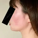 脂肪溶解注射（顔） 赤坂プレミアクリニック DAY 8 サムネイル用