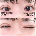 二重切開 / 目元修正 水の森美容クリニック 名古屋院 DAY 18 サムネイル用