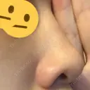 その他（鼻） 湘南美容クリニック 横須賀中央院 DAY 11 サムネイル用