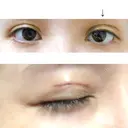 二重埋没 / 自然癒着法 表参道スキンクリニック 名古屋院（DAILY SKIN CLINIC提携院） DAY 0 サムネイル用