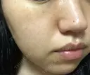 シミ取りレーザー / ピコレーザートーニング（美白・肝斑） UB CLINIC銀座 DAY 4 サムネイル用