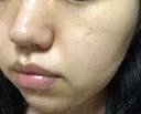 シミ取りレーザー / ピコレーザートーニング（美白・肝斑） UB CLINIC銀座 DAY 4 サムネイル用