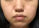 シミ取りレーザー / ピコレーザートーニング（美白・肝斑） UB CLINIC銀座 DAY 4 サムネイル用