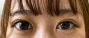 二重埋没 ながしまクリニック DAY 23 サムネイル用