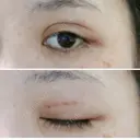 二重埋没 / 自然癒着法 表参道スキンクリニック 名古屋院（DAILY SKIN CLINIC提携院） DAY 1 サムネイル用