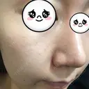 鼻尖形成（切開） / ヒアルロン酸注入（鼻） 東京ヒルズクリニック 新宿院 AFTER サムネイル用