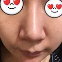 鼻尖形成（切開） / ヒアルロン酸注入（鼻） 東京ヒルズクリニック 新宿院 DAY 93 サムネイル用