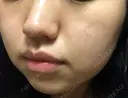 シミ取りレーザー / ピコレーザートーニング（美白・肝斑） UB CLINIC銀座 DAY 5 サムネイル用