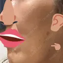 ボトックス（エラ・小顔） 湘南美容クリニック 藤沢院 DAY 0 サムネイル用