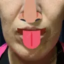 ボトックス（エラ・小顔） 湘南美容クリニック 藤沢院 DAY 3 サムネイル用