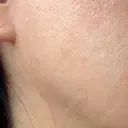 ボトックス（エラ・小顔） 湘南美容クリニック 藤沢院 DAY 6 サムネイル用