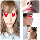 鼻中隔延長（切開） / 軟骨移植 / 鼻修正 / 傷跡修正 神戸大学附属病院 美容外科 DAY 34 サムネイル用