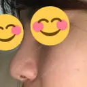 隆鼻術 たにまちクリニック DAY 67 サムネイル用