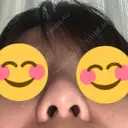 隆鼻術 たにまちクリニック AFTER サムネイル用