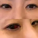 クマ治療 / 下まぶたたるみ取り / 下まぶたの脂肪取り 品川美容外科 渋谷院（※品川スキンクリニック提携） DAY 2 サムネイル用