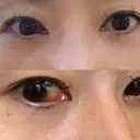 クマ治療 / 下まぶたたるみ取り / 下まぶたの脂肪取り 品川美容外科 渋谷院（※品川スキンクリニック提携） DAY 10 サムネイル用