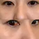 クマ治療 / 下まぶたたるみ取り / 下まぶたの脂肪取り 品川美容外科 渋谷院（※品川スキンクリニック提携） DAY 12 サムネイル用
