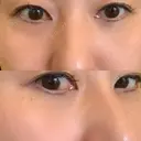 クマ治療 / 下まぶたたるみ取り / 下まぶたの脂肪取り 品川美容外科 渋谷院（※品川スキンクリニック提携） AFTER サムネイル用