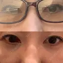 クマ治療 / 下まぶたたるみ取り / 下まぶたの脂肪取り 品川美容外科 渋谷院（※品川スキンクリニック提携） DAY 5 サムネイル用