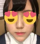 ヒアルロン酸注入（鼻） / ヒアルロン酸注入（あご） TCB東京中央美容外科 福島院 DAY 0 サムネイル用