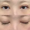二重切開 松下皮フ形成外科 DAY 7 サムネイル用