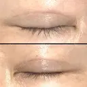 二重切開 / 眼瞼下垂（切開） / 上まぶたの脂肪取り / タレ目形成・グラマラスライン（切開） / 目尻靭帯移動 エイペックス美容外科 DAY 90 サムネイル用