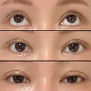二重切開 / 眼瞼下垂（切開） / 上まぶたの脂肪取り / タレ目形成・グラマラスライン（切開） / 目尻靭帯移動 エイペックス美容外科 DAY 90 サムネイル用