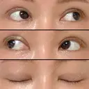 二重切開 / 眼瞼下垂（切開） / 上まぶたの脂肪取り / タレ目形成・グラマラスライン（切開） / 目尻靭帯移動 エイペックス美容外科 DAY 90 サムネイル用