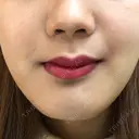 その他（輪郭） / その他（審美歯科/矯正歯科） 湘南美容クリニック 新宿本院 DAY 12 サムネイル用