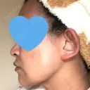 ハイフ（顔） / イオン導入 湘南美容クリニック 奈良院 DAY 31 サムネイル用