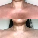 ボトックス（肩） 湘南美容クリニック 奈良院 DAY 31 サムネイル用