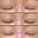 二重切開 / 眼瞼下垂（切開） / 上まぶたの脂肪取り / タレ目形成・グラマラスライン（切開） / 目尻靭帯移動 エイペックス美容外科 DAY 105 サムネイル用