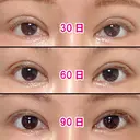 二重切開 / 眼瞼下垂（切開） / 上まぶたの脂肪取り / タレ目形成・グラマラスライン（切開） / 目尻靭帯移動 エイペックス美容外科 DAY 105 サムネイル用