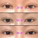 二重切開 / 眼瞼下垂（切開） / 上まぶたの脂肪取り / タレ目形成・グラマラスライン（切開） / 目尻靭帯移動 エイペックス美容外科 DAY 105 サムネイル用