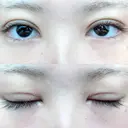 二重切開 松下皮フ形成外科 DAY 10 サムネイル用