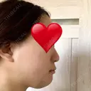 骨切り（あご） / 骨削り（エラ） リラ・クラニオフェイシャル・クリニック DAY 63 サムネイル用