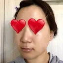 骨切り（あご） / 骨削り（エラ） リラ・クラニオフェイシャル・クリニック DAY 63 サムネイル用