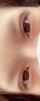 二重埋没 メディカルビューティセンター DAY 1 サムネイル用