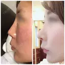 鼻尖形成（切開） / 鼻中隔延長（切開） / 軟骨移植 / 鼻翼基部形成（貴族手術） HANABI整形外科 AFTER サムネイル用