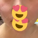 ヒアルロン酸注入（あご） 聖心美容クリニック 大阪院 DAY 35 サムネイル用