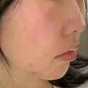 ヒアルロン酸注入（あご） 聖心美容クリニック 大阪院 DAY 35 サムネイル用
