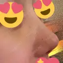 鼻尖形成（切開） / 小鼻縮小（切開） / その他（鼻） / 軟骨移植 / ワシ鼻修正・ハンプ切除 / 鼻尖縮小 B-LINE CLINIC 池袋院 DAY 86 サムネイル用