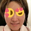 脂肪溶解注射（顔） 赤坂プレミアクリニック DAY 29 サムネイル用