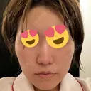 脂肪溶解注射（顔） 赤坂プレミアクリニック AFTER サムネイル用
