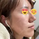 脂肪溶解注射（顔） / PRP皮膚再生療法 閉院｜プルージュ美容クリニック 赤羽院 DAY 24 サムネイル用